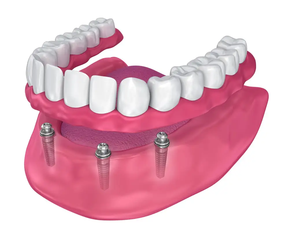 clinica stomatologică, implant dentar, dinți ficși, chirurgie oro-maxilo-facială, tratament stomatologic, proteză dentară, consultație stomatologică, medic dentist, estetică dentară, sănătate orală, dantură fixă, recenzii pacienți, servicii dentare, dantură completă, implant digital, parteneri implanturi, ghid chirurgical, echipă stomatologică, prețuri implanturi, prevenție dentară, clinica stomatologică București, implant dentar București, dinți ficși București, chirurgie oro-maxilo-facială București, tratament stomatologic București, proteză dentară București, consultație stomatologică București, medic dentist București, estetică dentară București, sănătate orală București, dantură fixă București, recenzii pacienți București, servicii dentare București, dantură completă București, implant digital București, parteneri implanturi București, ghid chirurgical București, echipă stomatologică București, prețuri implanturi București, prevenție dentară București