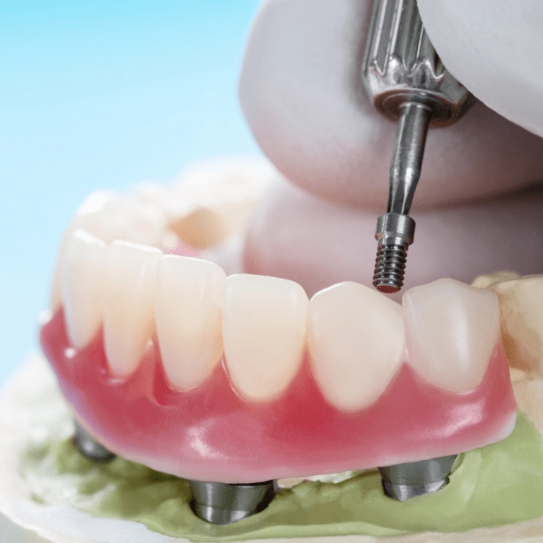 clinica stomatologică, implant dentar, dinți ficși, chirurgie oro-maxilo-facială, tratament stomatologic, proteză dentară, consultație stomatologică, medic dentist, estetică dentară, sănătate orală, dantură fixă, recenzii pacienți, servicii dentare, dantură completă, implant digital, parteneri implanturi, ghid chirurgical, echipă stomatologică, prețuri implanturi, prevenție dentară, clinica stomatologică București, implant dentar București, dinți ficși București, chirurgie oro-maxilo-facială București, tratament stomatologic București, proteză dentară București, consultație stomatologică București, medic dentist București, estetică dentară București, sănătate orală București, dantură fixă București, recenzii pacienți București, servicii dentare București, dantură completă București, implant digital București, parteneri implanturi București, ghid chirurgical București, echipă stomatologică București, prețuri implanturi București, prevenție dentară București