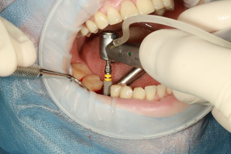 Implant dentar dent-park