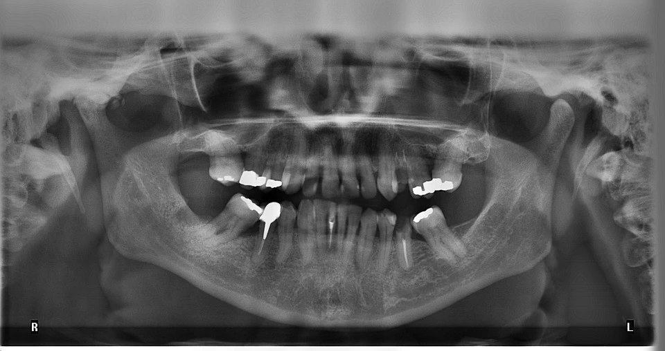 clinica stomatologică, implant dentar, dinți ficși, chirurgie oro-maxilo-facială, tratament stomatologic, proteză dentară, consultație stomatologică, medic dentist, estetică dentară, sănătate orală, dantură fixă, recenzii pacienți, servicii dentare, dantură completă, implant digital, parteneri implanturi, ghid chirurgical, echipă stomatologică, prețuri implanturi, prevenție dentară, clinica stomatologică București, implant dentar București, dinți ficși București, chirurgie oro-maxilo-facială București, tratament stomatologic București, proteză dentară București, consultație stomatologică București, medic dentist București, estetică dentară București, sănătate orală București, dantură fixă București, recenzii pacienți București, servicii dentare București, dantură completă București, implant digital București, parteneri implanturi București, ghid chirurgical București, echipă stomatologică București, prețuri implanturi București, prevenție dentară București