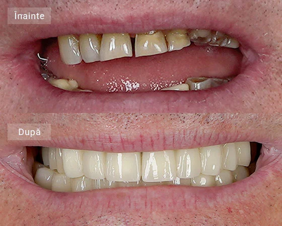 before after dorel
