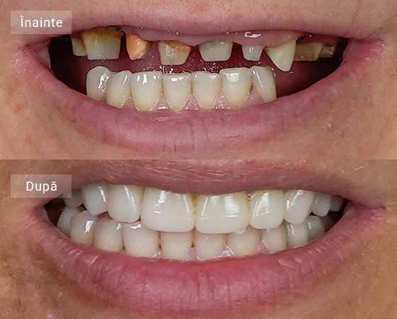before after miruna