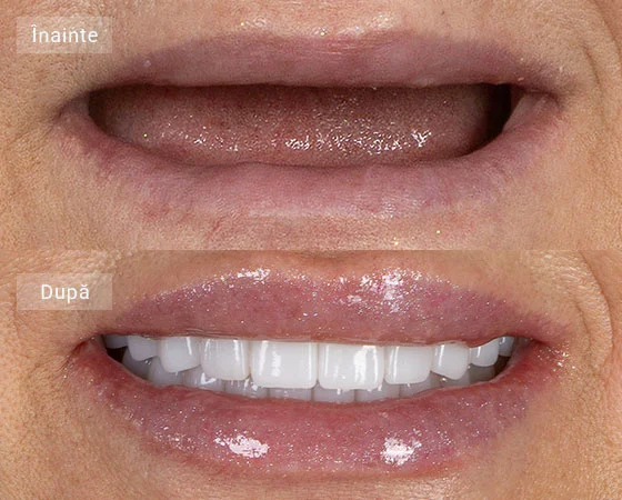 before after luminita