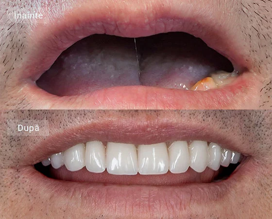 before after viorel