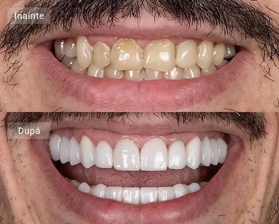 before after andrei