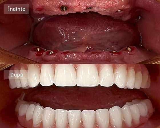 Cazuri 13 Bucur Alexandru before after