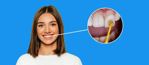 Fatete dentare