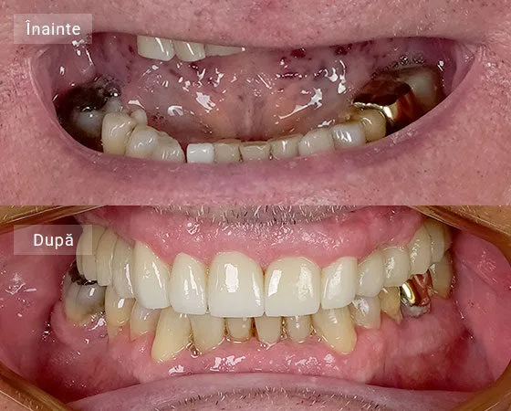 before after Manciu Ionel