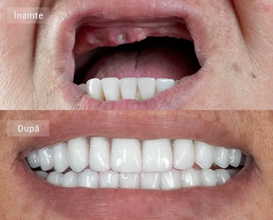 before after Marin Carmen