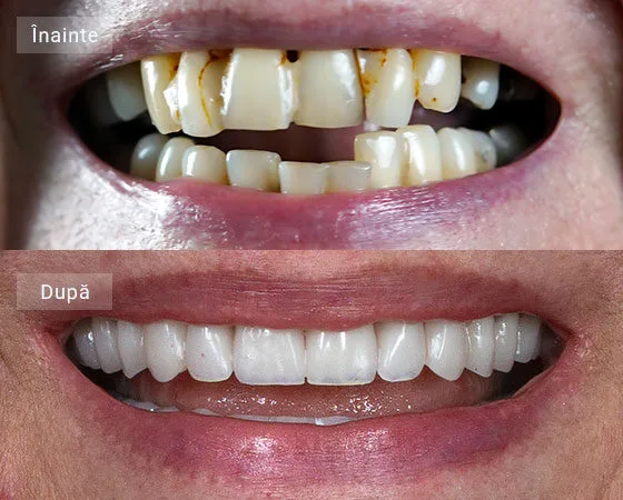 before after niculescu