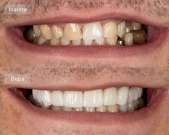 before after Cretu Cezar