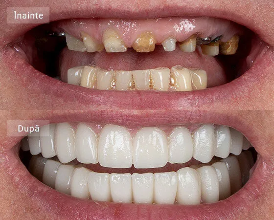before after Miut Lorena