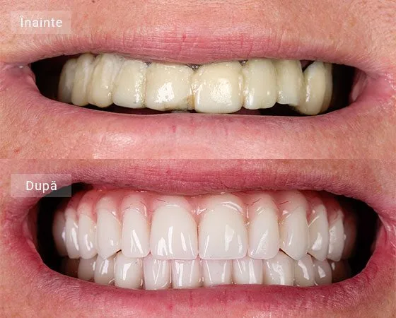 before after Ducanu Ioana