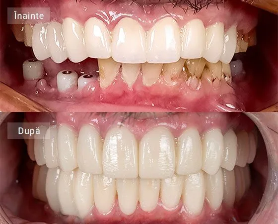 before after Otelea George