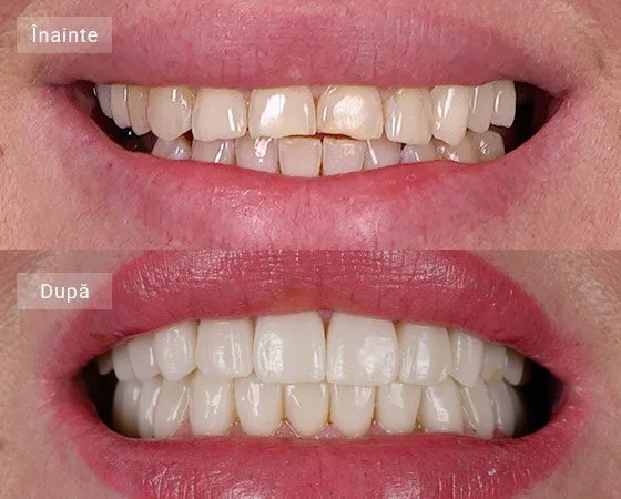 before after Stefanescu Laura