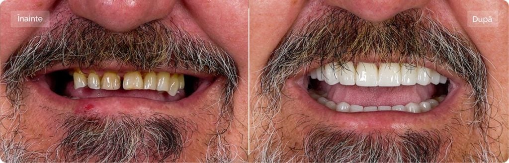 before after 2