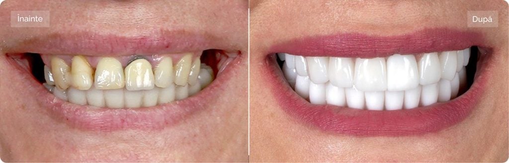 DANTURĂ FIXĂ PE IMPLANTURI ȘI IMPLANTURI DENTARE - CRISTINA, 40 DE ANI 1 before after 3