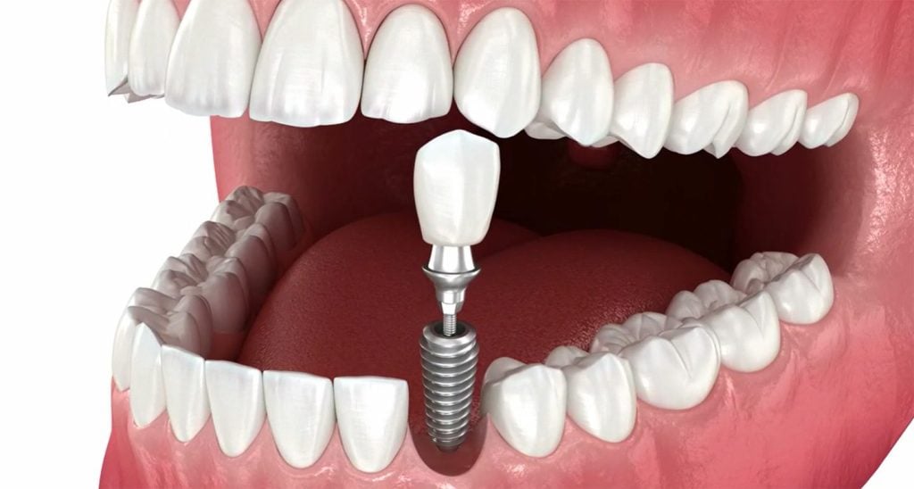 Implant dentar sau punte dentara - tu stii ce varianta sa alegi? 1 implant dentar