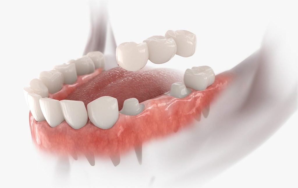 Implant dentar sau punte dentara - tu stii ce varianta sa alegi? 2 punte dentara