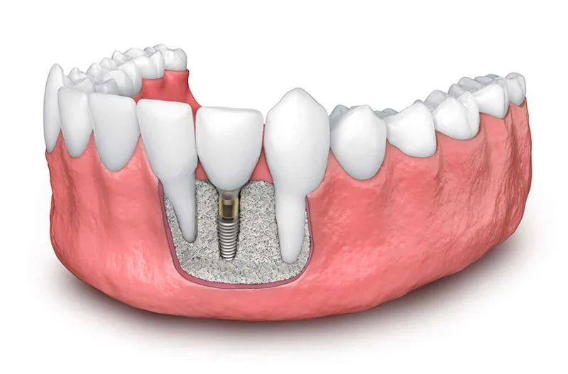 Procedură chirurgicală de augmentare osoasă realizată în clinica Dent Park București