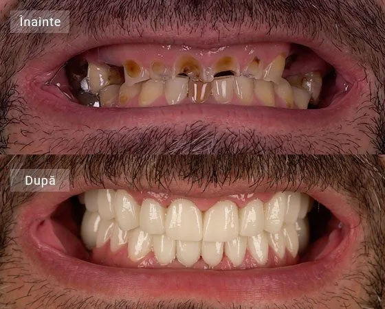 pareri implant dentar caz bucur marius
