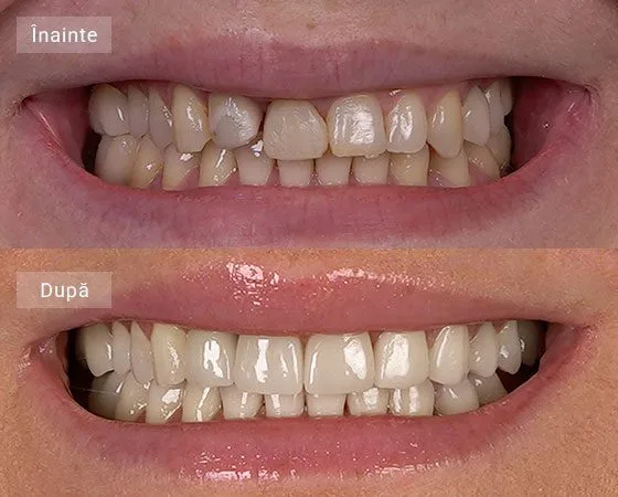 pareri implant dentar caz neculai cristina