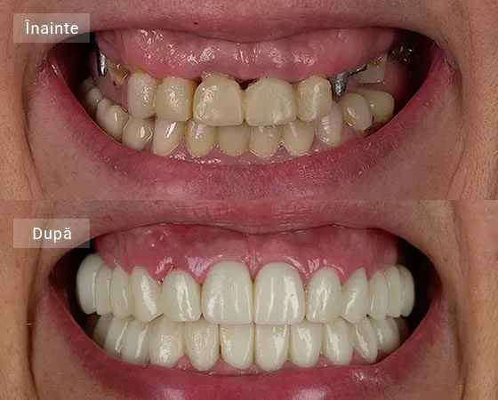 pareri implant dentar caz udroiu ana