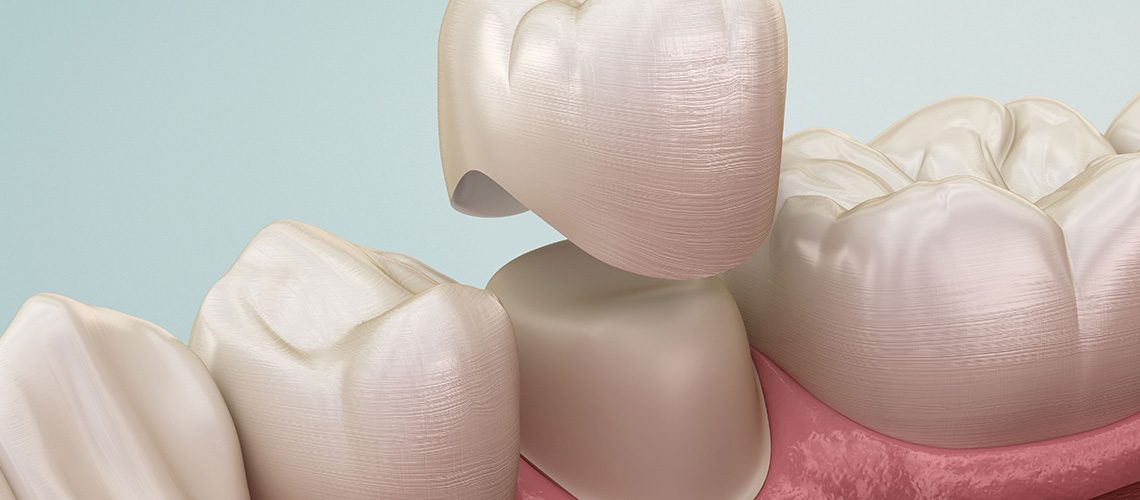 Coroană provizorie – protecție și stabilitate până la lucrarea finală