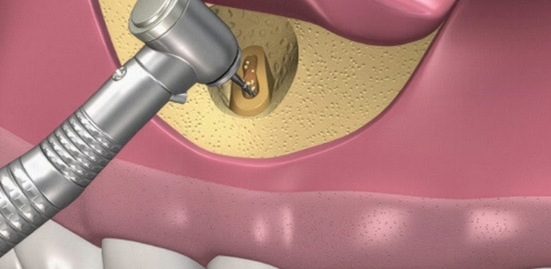 Rezecție apicală (apicoectomie) în București