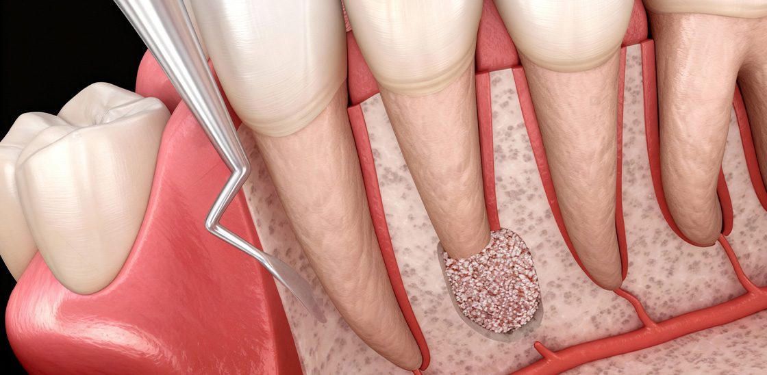 chistectomie dentara