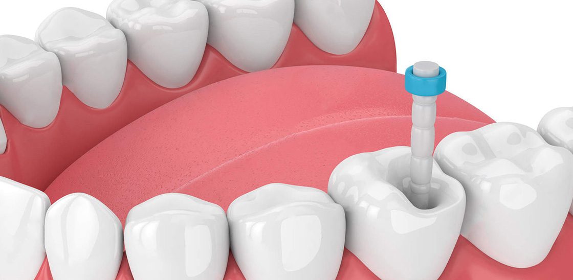 pivot fibra de sticla