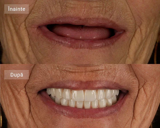 before after vasilica florea