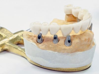clinica stomatologică, implant dentar, dinți ficși, chirurgie oro-maxilo-facială, tratament stomatologic, proteză dentară, consultație stomatologică, medic dentist, estetică dentară, sănătate orală, dantură fixă, recenzii pacienți, servicii dentare, dantură completă, implant digital, parteneri implanturi, ghid chirurgical, echipă stomatologică, prețuri implanturi, prevenție dentară, clinica stomatologică București, implant dentar București, dinți ficși București, chirurgie oro-maxilo-facială București, tratament stomatologic București, proteză dentară București, consultație stomatologică București, medic dentist București, estetică dentară București, sănătate orală București, dantură fixă București, recenzii pacienți București, servicii dentare București, dantură completă București, implant digital București, parteneri implanturi București, ghid chirurgical București, echipă stomatologică București, prețuri implanturi București, prevenție dentară București