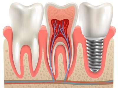 Implant-B&B