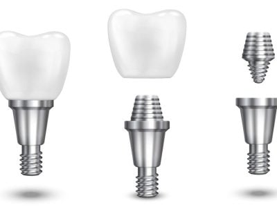 Implant-INNO