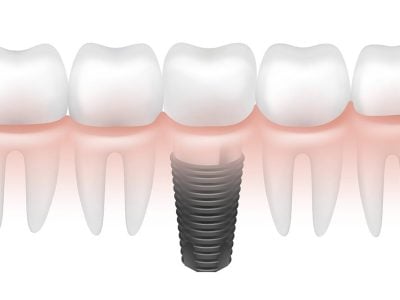 Implant-Straumann