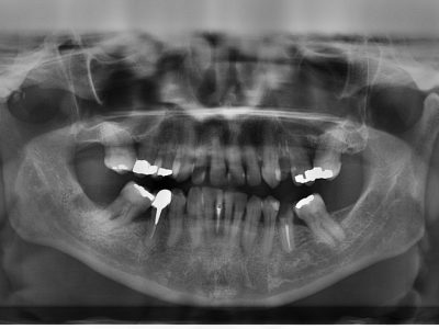 clinica stomatologică, implant dentar, dinți ficși, chirurgie oro-maxilo-facială, tratament stomatologic, proteză dentară, consultație stomatologică, medic dentist, estetică dentară, sănătate orală, dantură fixă, recenzii pacienți, servicii dentare, dantură completă, implant digital, parteneri implanturi, ghid chirurgical, echipă stomatologică, prețuri implanturi, prevenție dentară, clinica stomatologică București, implant dentar București, dinți ficși București, chirurgie oro-maxilo-facială București, tratament stomatologic București, proteză dentară București, consultație stomatologică București, medic dentist București, estetică dentară București, sănătate orală București, dantură fixă București, recenzii pacienți București, servicii dentare București, dantură completă București, implant digital București, parteneri implanturi București, ghid chirurgical București, echipă stomatologică București, prețuri implanturi București, prevenție dentară București