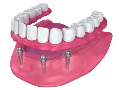 clinica stomatologică, implant dentar, dinți ficși, chirurgie oro-maxilo-facială, tratament stomatologic, proteză dentară, consultație stomatologică, medic dentist, estetică dentară, sănătate orală, dantură fixă, recenzii pacienți, servicii dentare, dantură completă, implant digital, parteneri implanturi, ghid chirurgical, echipă stomatologică, prețuri implanturi, prevenție dentară, clinica stomatologică București, implant dentar București, dinți ficși București, chirurgie oro-maxilo-facială București, tratament stomatologic București, proteză dentară București, consultație stomatologică București, medic dentist București, estetică dentară București, sănătate orală București, dantură fixă București, recenzii pacienți București, servicii dentare București, dantură completă București, implant digital București, parteneri implanturi București, ghid chirurgical București, echipă stomatologică București, prețuri implanturi București, prevenție dentară București