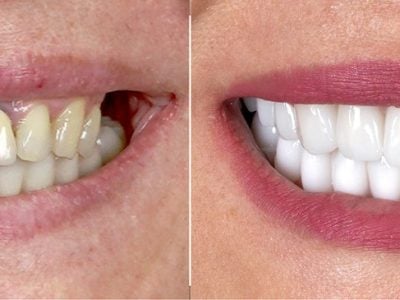 before-after