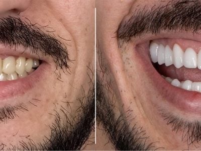 before-after