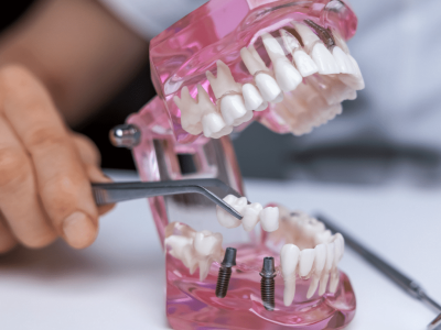 clinica stomatologică, implant dentar, dinți ficși, chirurgie oro-maxilo-facială, tratament stomatologic, proteză dentară, consultație stomatologică, medic dentist, estetică dentară, sănătate orală, dantură fixă, recenzii pacienți, servicii dentare, dantură completă, implant digital, parteneri implanturi, ghid chirurgical, echipă stomatologică, prețuri implanturi, prevenție dentară, clinica stomatologică București, implant dentar București, dinți ficși București, chirurgie oro-maxilo-facială București, tratament stomatologic București, proteză dentară București, consultație stomatologică București, medic dentist București, estetică dentară București, sănătate orală București, dantură fixă București, recenzii pacienți București, servicii dentare București, dantură completă București, implant digital București, parteneri implanturi București, ghid chirurgical București, echipă stomatologică București, prețuri implanturi București, prevenție dentară București