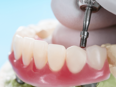 clinica stomatologică, implant dentar, dinți ficși, chirurgie oro-maxilo-facială, tratament stomatologic, proteză dentară, consultație stomatologică, medic dentist, estetică dentară, sănătate orală, dantură fixă, recenzii pacienți, servicii dentare, dantură completă, implant digital, parteneri implanturi, ghid chirurgical, echipă stomatologică, prețuri implanturi, prevenție dentară, clinica stomatologică București, implant dentar București, dinți ficși București, chirurgie oro-maxilo-facială București, tratament stomatologic București, proteză dentară București, consultație stomatologică București, medic dentist București, estetică dentară București, sănătate orală București, dantură fixă București, recenzii pacienți București, servicii dentare București, dantură completă București, implant digital București, parteneri implanturi București, ghid chirurgical București, echipă stomatologică București, prețuri implanturi București, prevenție dentară București