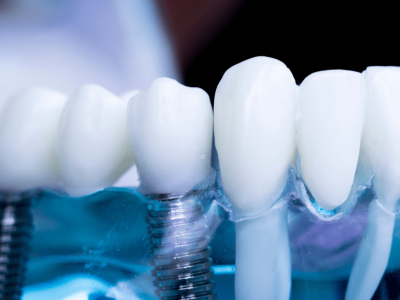 clinica stomatologică, implant dentar, dinți ficși, chirurgie oro-maxilo-facială, tratament stomatologic, proteză dentară, consultație stomatologică, medic dentist, estetică dentară, sănătate orală, dantură fixă, recenzii pacienți, servicii dentare, dantură completă, implant digital, parteneri implanturi, ghid chirurgical, echipă stomatologică, prețuri implanturi, prevenție dentară, clinica stomatologică București, implant dentar București, dinți ficși București, chirurgie oro-maxilo-facială București, tratament stomatologic București, proteză dentară București, consultație stomatologică București, medic dentist București, estetică dentară București, sănătate orală București, dantură fixă București, recenzii pacienți București, servicii dentare București, dantură completă București, implant digital București, parteneri implanturi București, ghid chirurgical București, echipă stomatologică București, prețuri implanturi București, prevenție dentară București