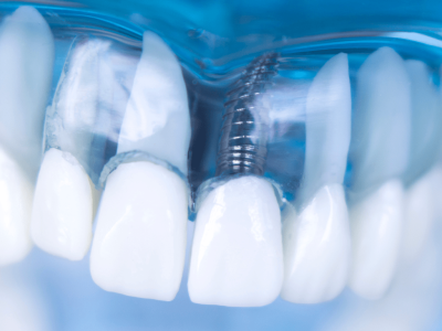 clinica stomatologică, implant dentar, dinți ficși, chirurgie oro-maxilo-facială, tratament stomatologic, proteză dentară, consultație stomatologică, medic dentist, estetică dentară, sănătate orală, dantură fixă, recenzii pacienți, servicii dentare, dantură completă, implant digital, parteneri implanturi, ghid chirurgical, echipă stomatologică, prețuri implanturi, prevenție dentară, clinica stomatologică București, implant dentar București, dinți ficși București, chirurgie oro-maxilo-facială București, tratament stomatologic București, proteză dentară București, consultație stomatologică București, medic dentist București, estetică dentară București, sănătate orală București, dantură fixă București, recenzii pacienți București, servicii dentare București, dantură completă București, implant digital București, parteneri implanturi București, ghid chirurgical București, echipă stomatologică București, prețuri implanturi București, prevenție dentară București