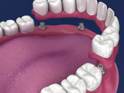 clinica stomatologică, implant dentar, dinți ficși, chirurgie oro-maxilo-facială, tratament stomatologic, proteză dentară, consultație stomatologică, medic dentist, estetică dentară, sănătate orală, dantură fixă, recenzii pacienți, servicii dentare, dantură completă, implant digital, parteneri implanturi, ghid chirurgical, echipă stomatologică, prețuri implanturi, prevenție dentară, clinica stomatologică București, implant dentar București, dinți ficși București, chirurgie oro-maxilo-facială București, tratament stomatologic București, proteză dentară București, consultație stomatologică București, medic dentist București, estetică dentară București, sănătate orală București, dantură fixă București, recenzii pacienți București, servicii dentare București, dantură completă București, implant digital București, parteneri implanturi București, ghid chirurgical București, echipă stomatologică București, prețuri implanturi București, prevenție dentară București