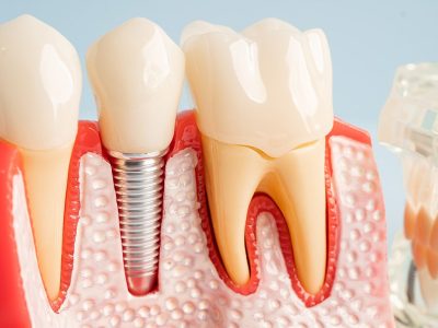 implant-dentar-de-calitate