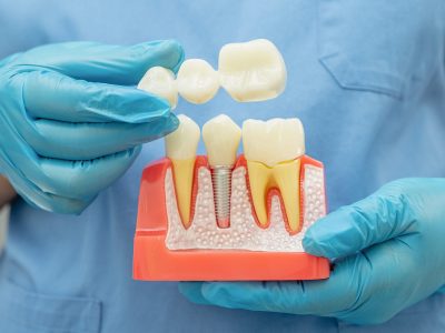 tipuri-coroane-zirconiu-ceramica-integrala