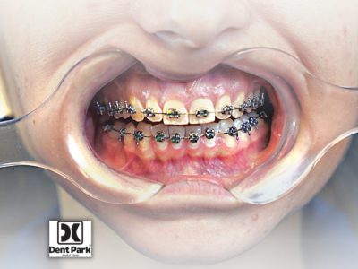 clinica stomatologică, implant dentar, dinți ficși, chirurgie oro-maxilo-facială, tratament stomatologic, proteză dentară, consultație stomatologică, medic dentist, estetică dentară, sănătate orală, dantură fixă, recenzii pacienți, servicii dentare, dantură completă, implant digital, parteneri implanturi, ghid chirurgical, echipă stomatologică, prețuri implanturi, prevenție dentară, clinica stomatologică București, implant dentar București, dinți ficși București, chirurgie oro-maxilo-facială București, tratament stomatologic București, proteză dentară București, consultație stomatologică București, medic dentist București, estetică dentară București, sănătate orală București, dantură fixă București, recenzii pacienți București, servicii dentare București, dantură completă București, implant digital București, parteneri implanturi București, ghid chirurgical București, echipă stomatologică București, prețuri implanturi București, prevenție dentară București